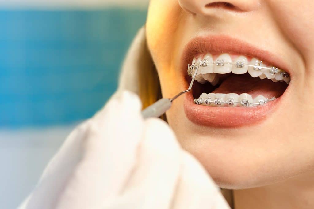 Adult Braces: Are They Right for You?
