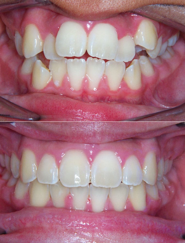Before and After FR