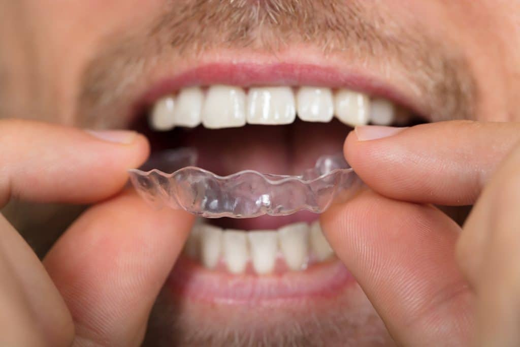 How Does Invisalign Work?