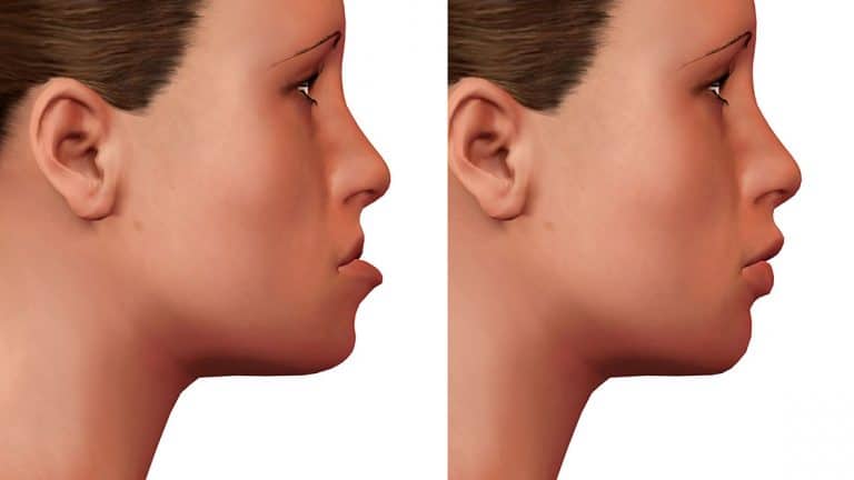 Orthognathic Surgery