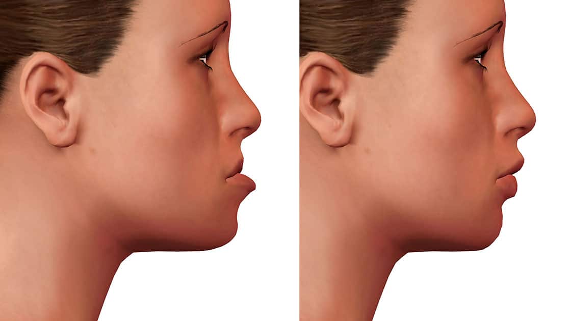 orthognathic surgery Graphic