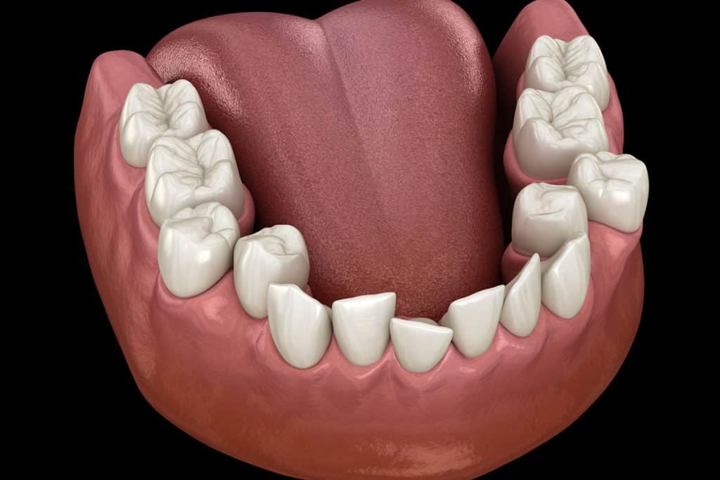 Understanding Dental Crowding